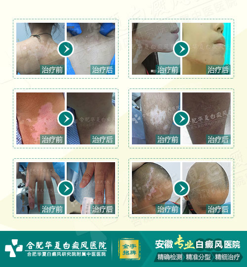 白癜风该如何治疗？