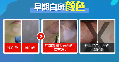 早期白斑颜色