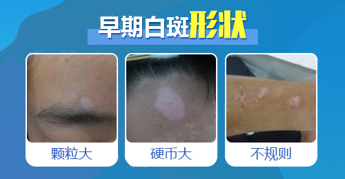 白斑形状